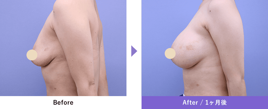 Before After / 1ヶ月後