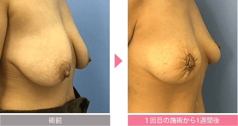 乳房縮小、乳房つり上げ 一回の施術から１週間後
