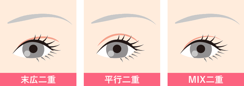 ドクターがおすすめする二重のデザイン