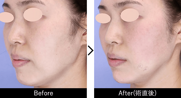 糸リフト症例写真n279297