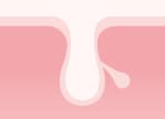ニキビでき始め～炎症中 イメージ