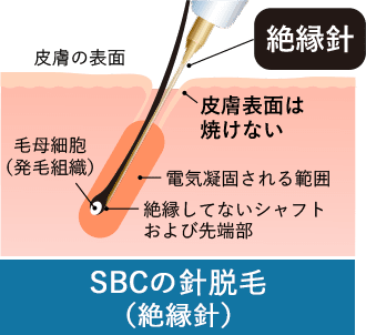 SBCのニードル脱毛(絶縁針)