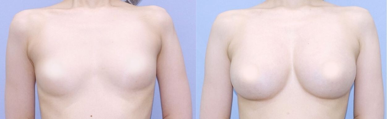豊胸のベスト症例写真