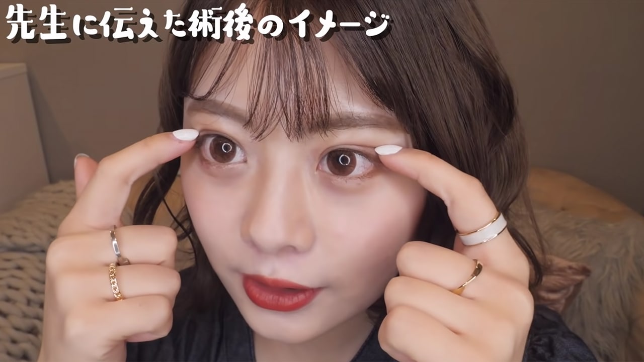 二重整形しました