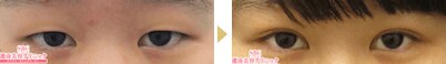まぶたの厚い方の症例04