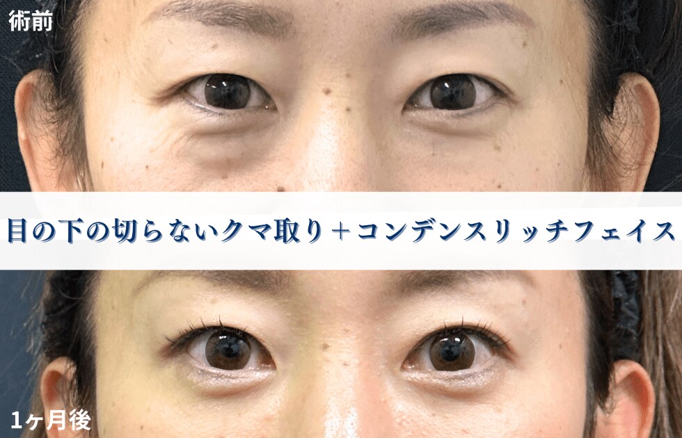 クマ取り症例