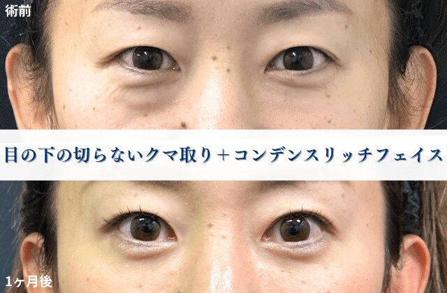 クマ取り症例