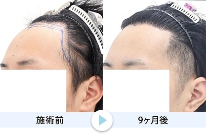 症例写真1