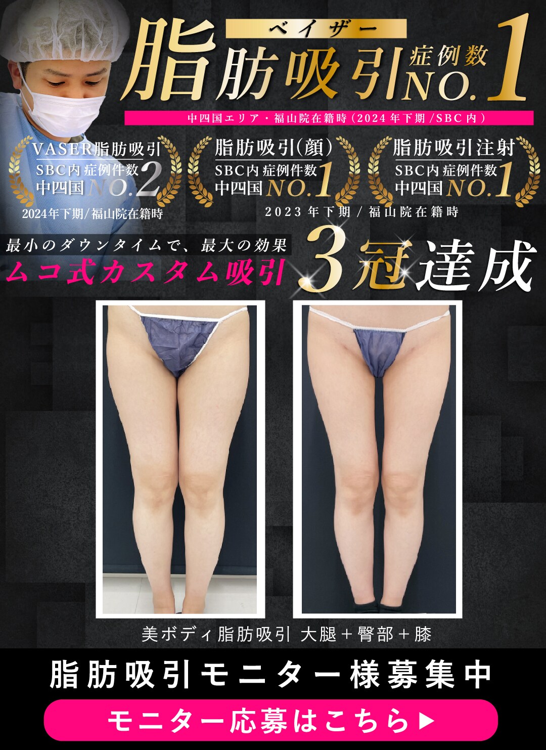 脂肪吸引No.2