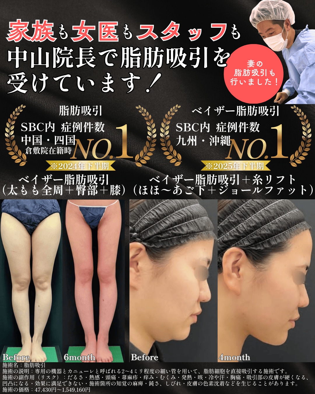 脂肪吸引