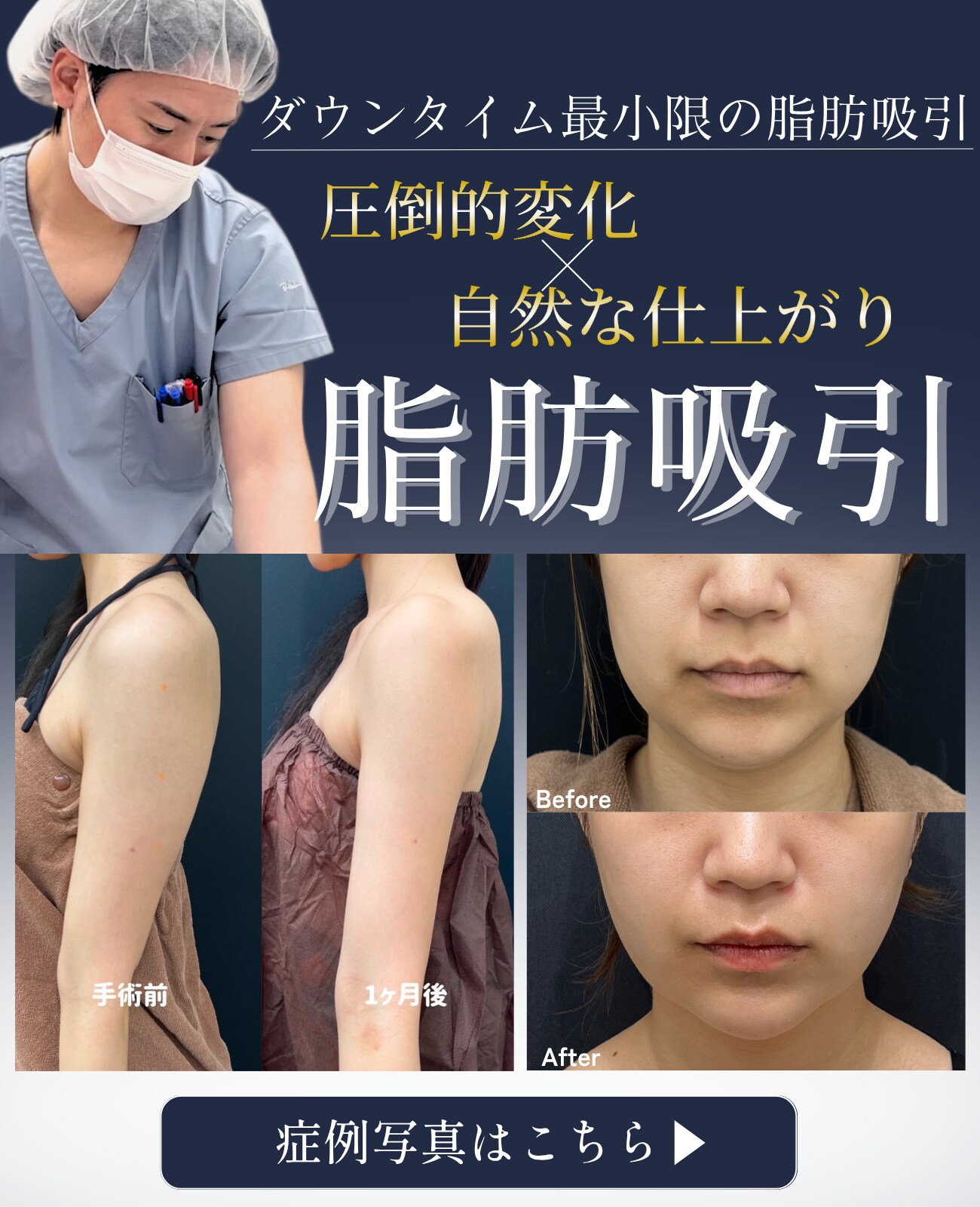 脂肪吸引モニター