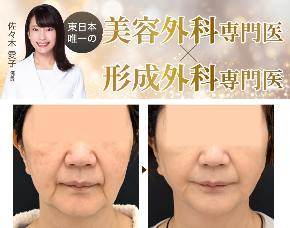 糸リフト症例