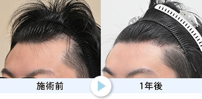 症例写真1