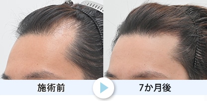 症例写真1