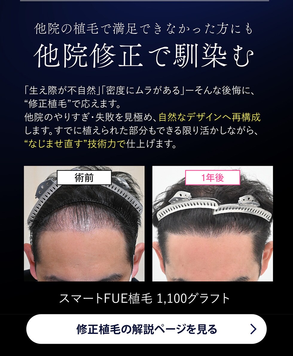 なじみ植毛