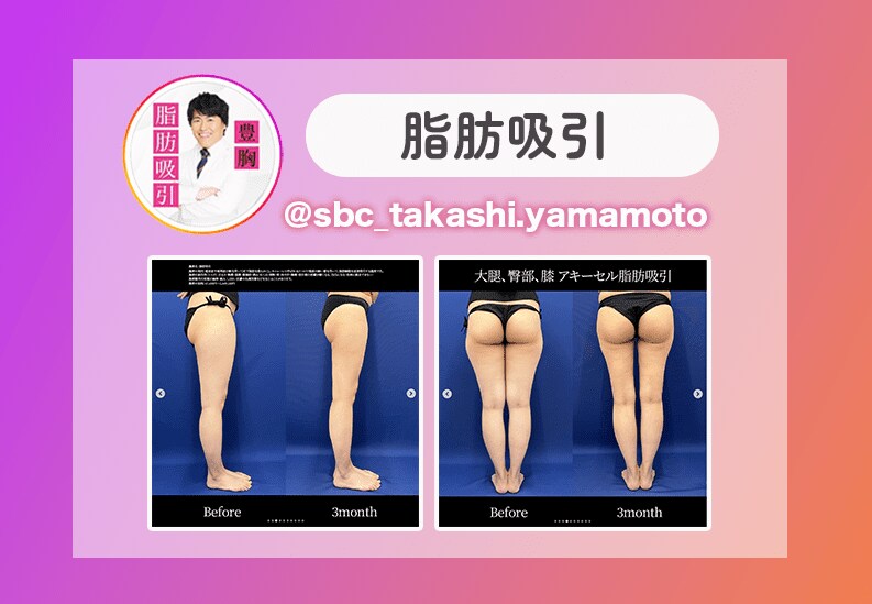 脂肪吸引