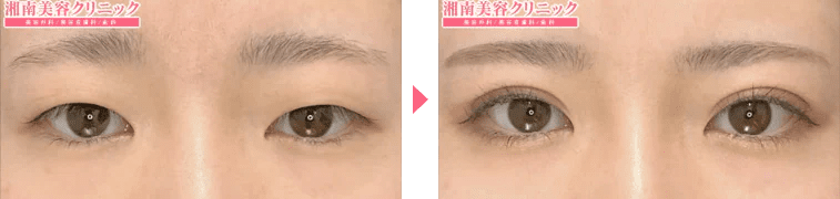 週末二重&reg;症例写真