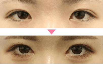 蒙古ひだ・目頭切開プレミアムの症例写真1 ビフォーアフター