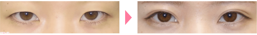 蒙古ひだ・目頭切開プレミアムの症例写真2 ビフォーアフター