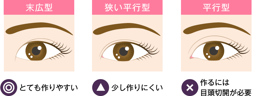 蒙古ひだがある人は平行二重になれないの？