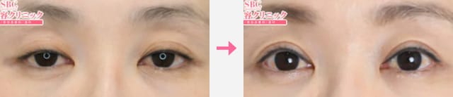 眼瞼下垂_症例写真02