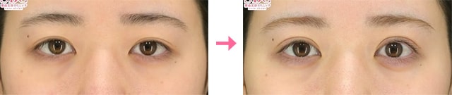 眼瞼下垂_症例写真03