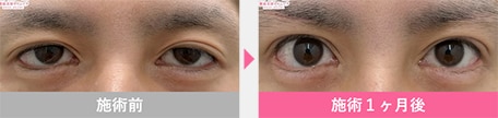 眼瞼下垂 症例写真4