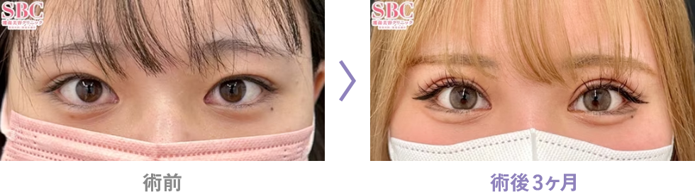 目尻切開プックアップ症例