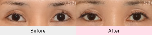 下眼瞼下制法（たれ目術）の症例写真1