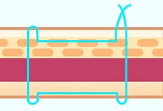 断面図 糸がループになり 癒着を作っています