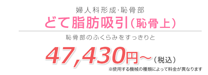 どて脂肪吸引(恥骨上)