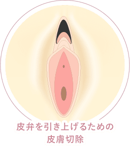 フェミニンリフト 切除 イメージ