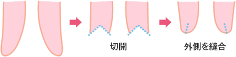 小陰唇の断面図と、小陰唇縮小手術のイメージ