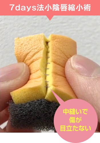 7days法小陰唇縮小術 中縫いで傷が目立たない