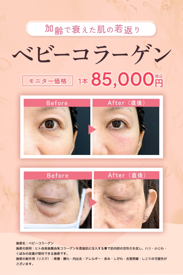 ベビーコラーゲン症例写真