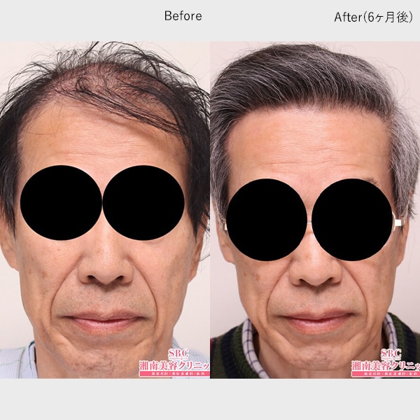 AGA薄毛治療