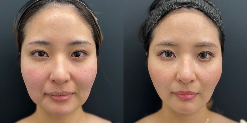 小顔施術 症例写真10