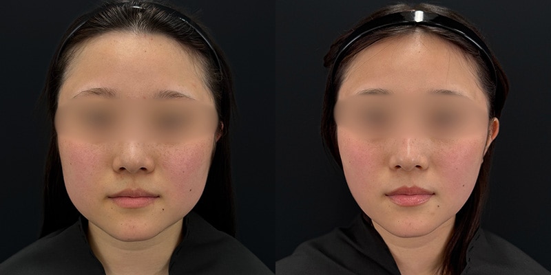 小顔施術 症例写真34