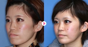 小顔整形（骨切り・骨削り）の症例写真5
