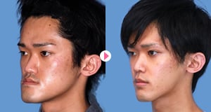 小顔整形（骨切り・骨削り）の症例写真6