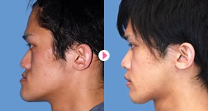 小顔整形（骨切り・骨削り）の症例写真7