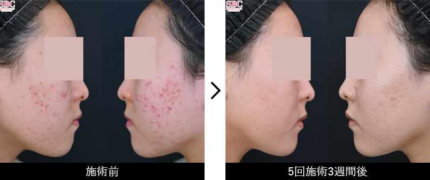 アクネライト&reg;症例写真 側面