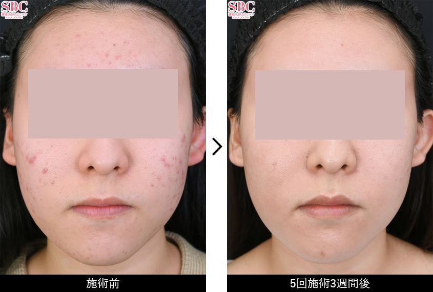アクネライト&reg;症例写真 正面