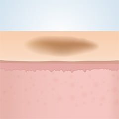 フラクショナルレーザー前