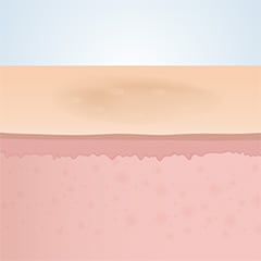 フラクショナルレーザー治療後