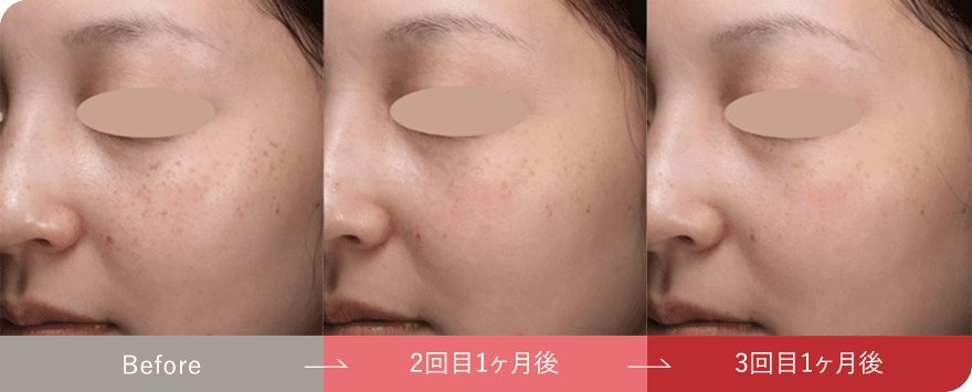 症例写真1