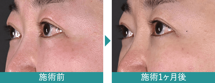 デンシティ 症例写真Before After