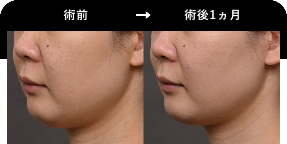 Before After