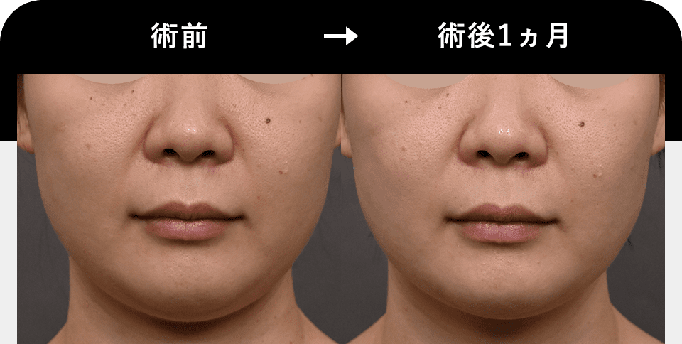 Before After