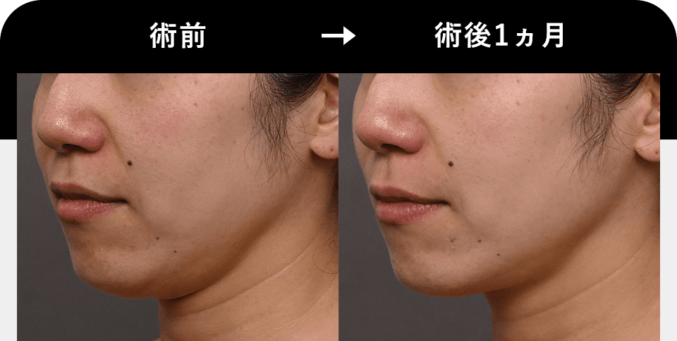 Before After